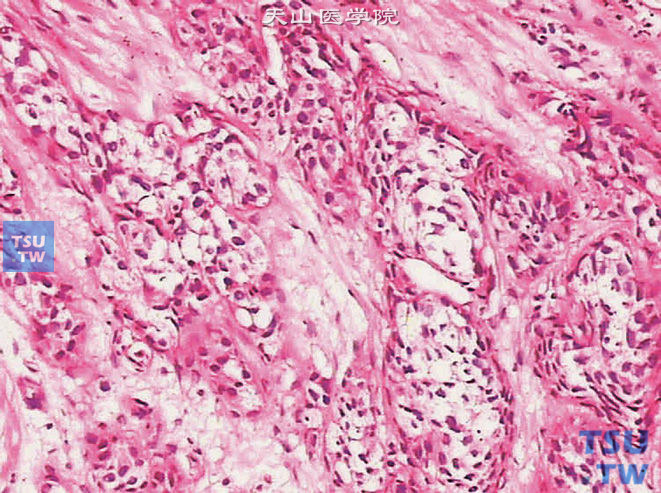 浸润性尿路上皮癌，透明细胞亚型。示胞质透明的肿瘤细胞呈巢片状分布