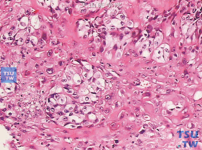 浸润性尿路上皮癌，透明细胞亚型。上图高倍，示胞质透明的肿瘤细胞呈巢片状分布