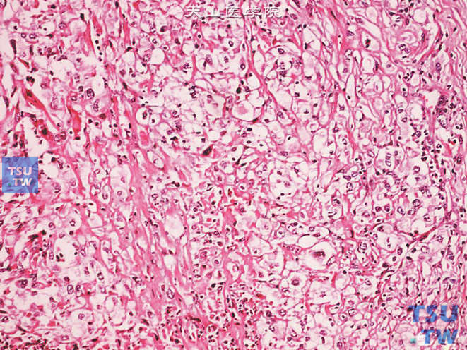 浸润性尿路上皮癌，透明细胞亚型。示成片排列的肿瘤细胞胞质丰富、透明