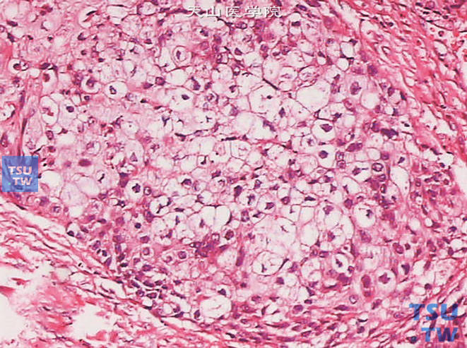 膀胱浸润性高级别尿路上皮癌，透明细胞变异型。肿瘤细胞胞质透明，可呈灶状或弥漫性生长