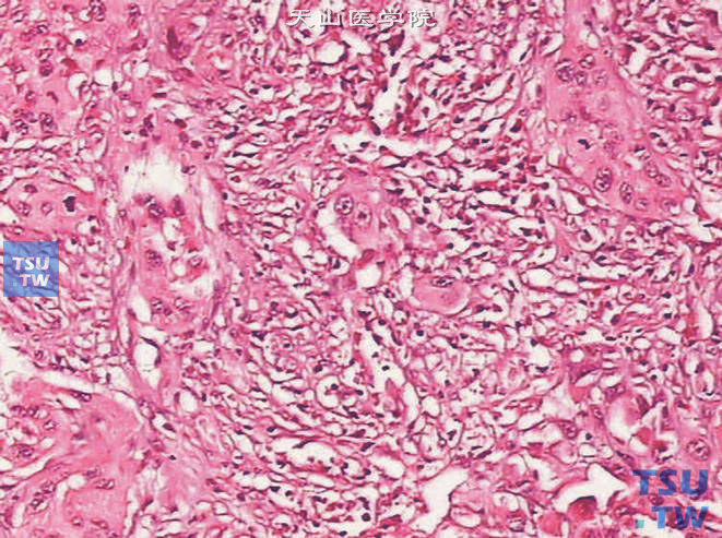 浸润性尿路上皮癌，淋巴上皮瘤样变异型。示上皮细胞呈合体细胞样表现，周围可见淋巴细胞
