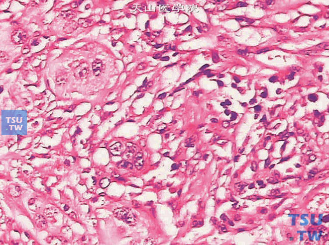 浸润性尿路上皮癌，淋巴上皮瘤样变异型。上图高倍，示上皮细胞呈合体细胞样表现，周围可见淋巴细胞