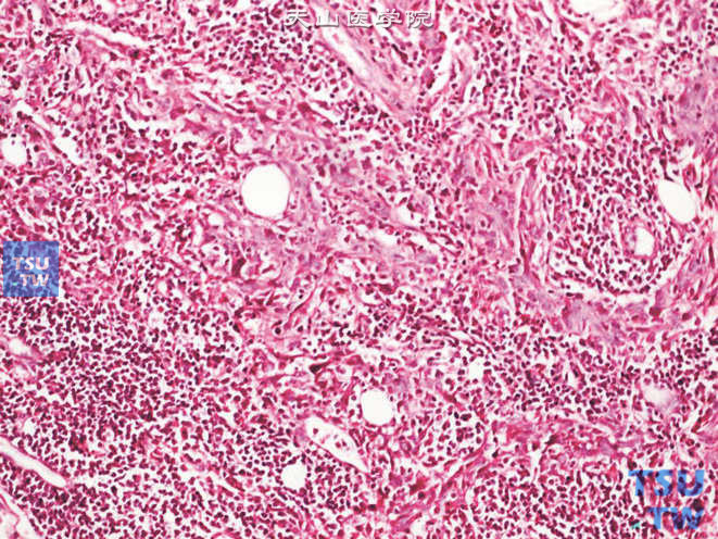 浸润性尿路上皮癌，淋巴上皮瘤样变异型，瘤细胞呈条索状排列，胞质分界不清，呈合体样外观，伴显著的淋巴样间质