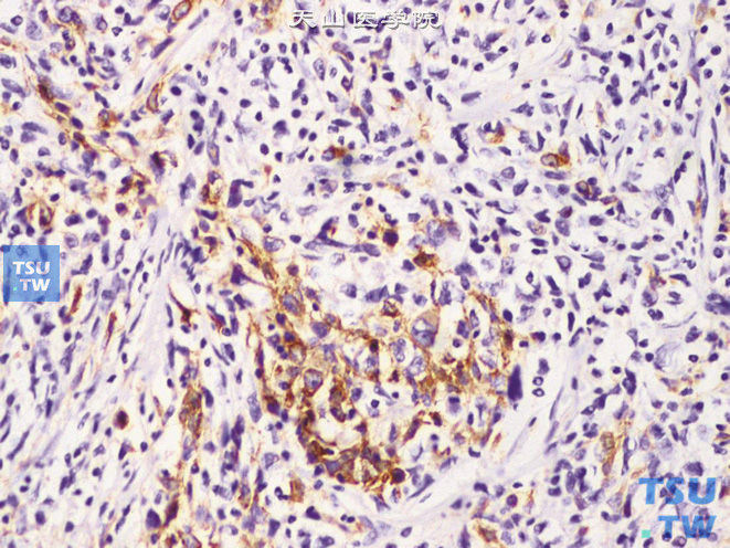 浸润性尿路上皮癌，淋巴上皮瘤样变异型，瘤细胞CK7（+）