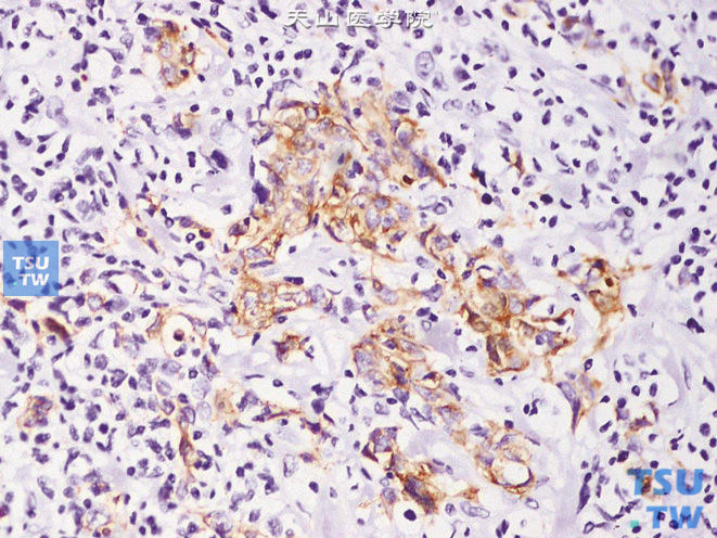 浸润性尿路上皮癌，淋巴上皮瘤样变异型，瘤细胞呈特征性CK（+）