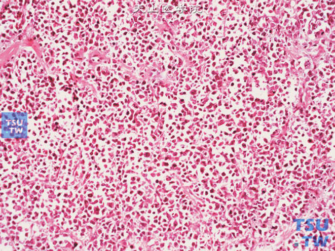 浸润性尿路上皮癌，淋巴瘤样和浆细胞样变异型，在疏松的间质中可见单个恶性细胞