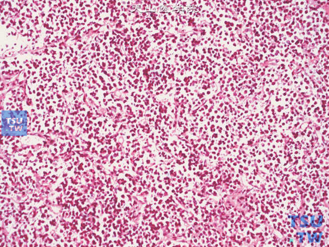 浸润性尿路上皮癌，淋巴瘤样和浆细胞样变异型，瘤细胞小，胞质稀少