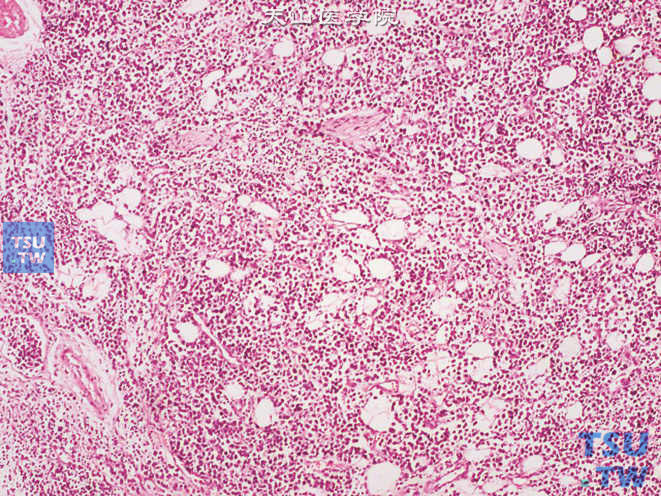 浸润性尿路上皮癌，淋巴瘤样和浆细胞样变异型，瘤细胞于脂肪组织中弥漫分布