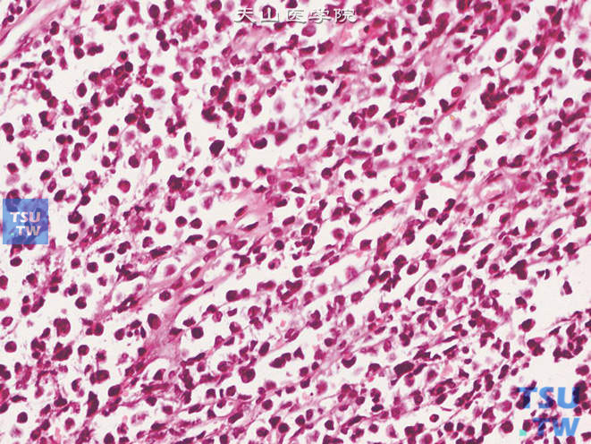 浸润性尿路上皮癌，淋巴瘤样和浆细胞样变异型，核浓染，偏位