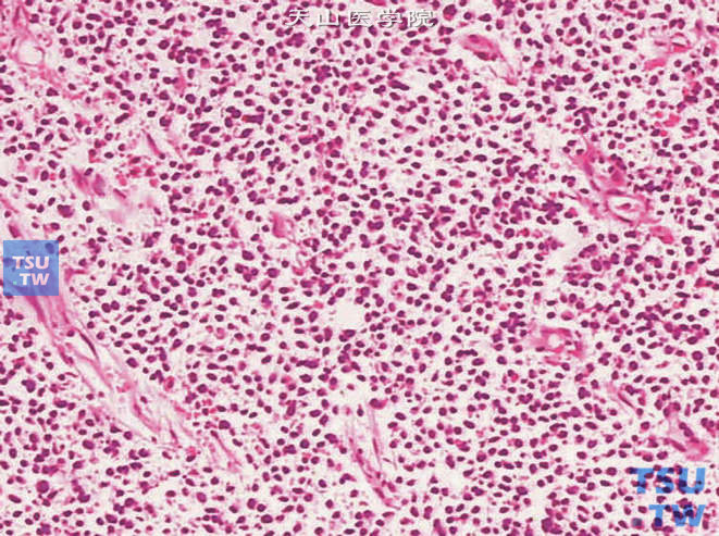 膀胱浸润性高级别尿路上皮癌，淋巴瘤样和浆细胞样变异型。示肿瘤细胞弥漫生长，形态类似于淋巴瘤