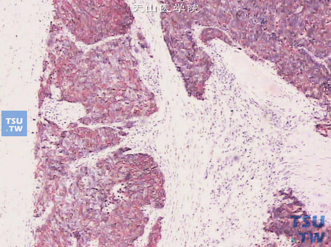浸润性尿路上皮癌伴神经内分泌分化（肾移植后），免疫组化CD56（+）