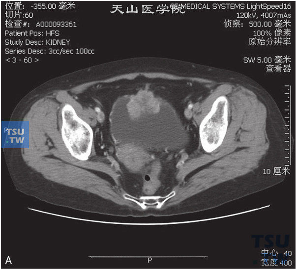 图A：CT示脐尿管癌。女，60岁，无痛肉眼血尿1个月余，尿排尽时略感疼痛。膀胱前上壁见软组织密度肿物，局部膀胱壁增厚，肿物前凸侵犯脐尿管末端，增强后明显强化