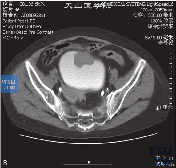 图B：CT示脐尿管癌。女，60岁，无痛肉眼血尿1个月余，尿排尽时略感疼痛。膀胱前上壁见软组织密度肿物，局部膀胱壁增厚，肿物前凸侵犯脐尿管末端，增强后明显强化