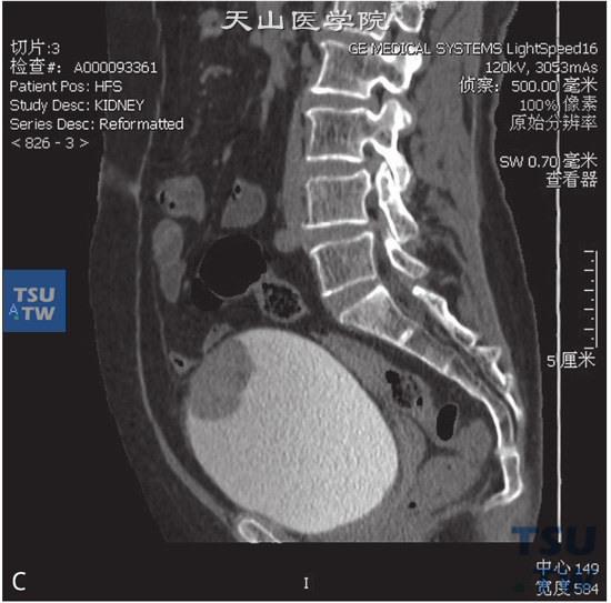 图C：CT示脐尿管癌。女，60岁，无痛肉眼血尿1个月余，尿排尽时略感疼痛。膀胱前上壁见软组织密度肿物，局部膀胱壁增厚，肿物前凸侵犯脐尿管末端，增强后明显强化