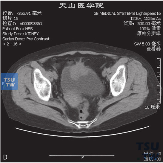 图D：CT示脐尿管癌。女，60岁，无痛肉眼血尿1个月余，尿排尽时略感疼痛。膀胱前上壁见软组织密度肿物，局部膀胱壁增厚，肿物前凸侵犯脐尿管末端，增强后明显强化