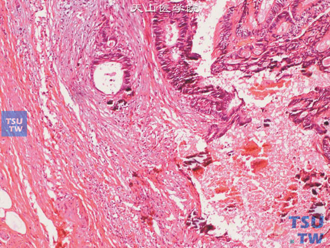 膀胱脐尿管癌，肿瘤于肌层中浸润生长