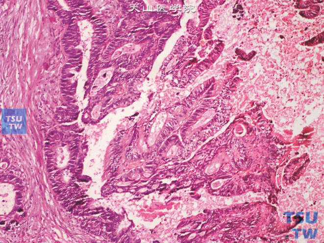 膀胱脐尿管癌，肠型，示复杂的腺管状结构及坏死