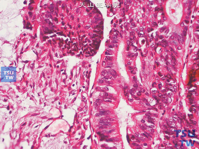 膀胱脐尿管癌，肠型，示瘤细胞腔面微绒毛样结构