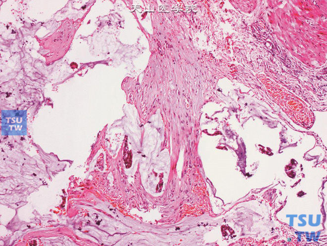 膀胱脐尿管癌，黏液（胶样）型，可见肿瘤细胞漂浮于黏液池中，右上角为膀胱壁肌组织