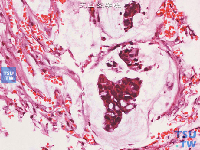 膀胱脐尿管癌，黏液（胶样）型，恶性肿瘤细胞漂浮于黏液池中，是脐尿管腺癌黏液（胶样）亚型的特征性改变