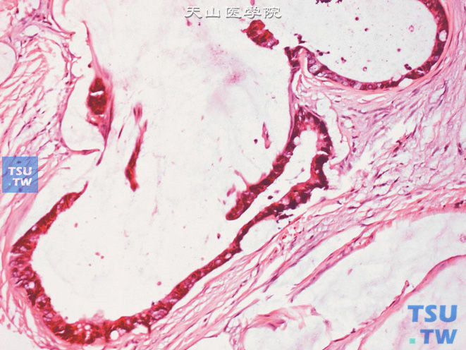 膀胱脐尿管癌，黏液（胶样）型，衬覆于纤维血管间隔的恶性肿瘤细胞围绕于特征性黏液池周围