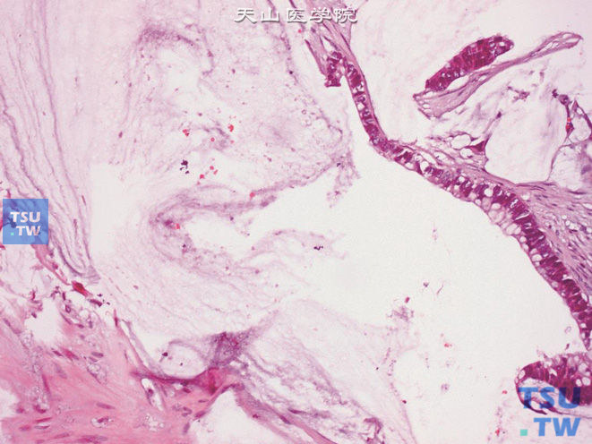 膀胱脐尿管癌，黏液（胶样）型，示一排产生黏液的细胞衬覆于纤维血管间隔，另一侧可见特征性黏液池