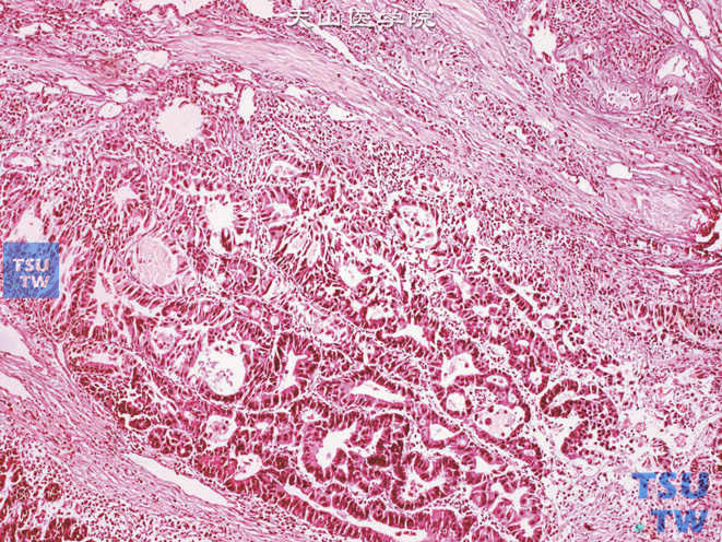 膀胱浸润性腺癌，非特殊型，侵犯肌层
