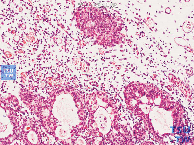 腺性膀胱炎恶变，示部分区域（图上方）腺腔基本消失