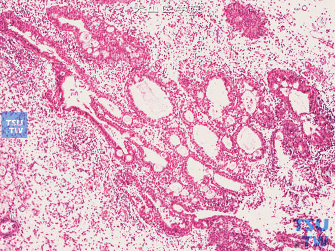 腺性膀胱炎恶变。可见不规则的腺性结构，细胞异型较明显