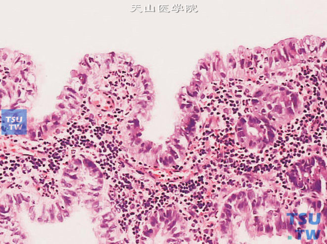 膀胱腺癌表层腺性化生。黏膜被覆上皮呈高柱状，部分细胞胞质内可见空泡