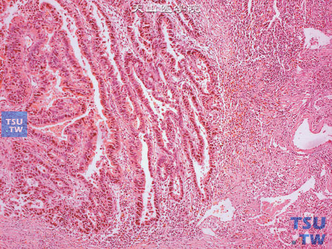 膀胱浸润性腺癌，注意黏膜表面的腺癌成分