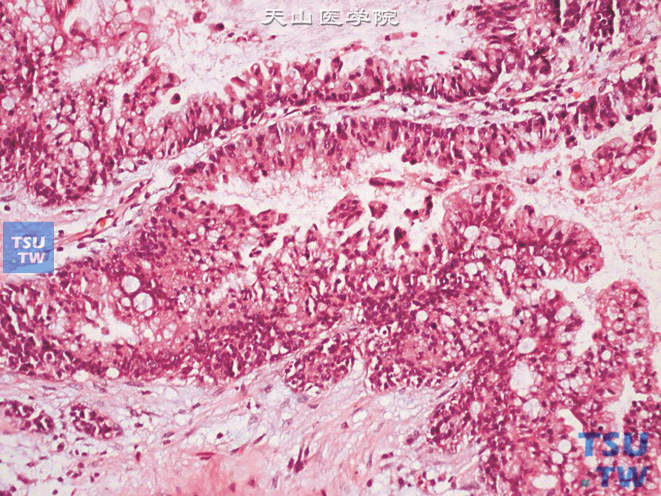 膀胱腺癌，肠（结肠）型，肿瘤细胞类似于肠上皮
