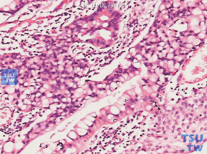 膀胱黏液腺癌，示肿瘤细胞生成黏液