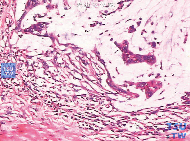 膀胱黏液腺癌，可见肿瘤细胞漂浮于黏液湖中