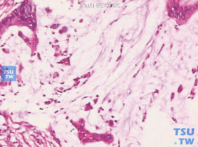 膀胱黏液腺癌，上图高倍。可见肿瘤细胞漂浮于黏液湖中。细胞异型明显
