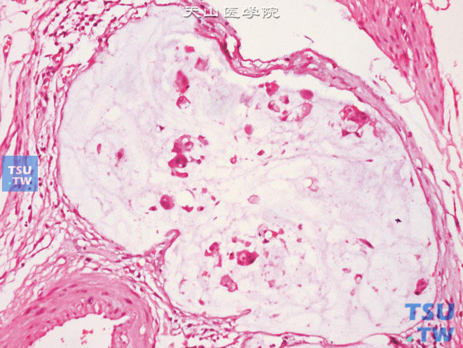 膀胱腺癌，黏液（胶样）型，可见富含黏液的肿瘤细胞漂浮于黏液湖中