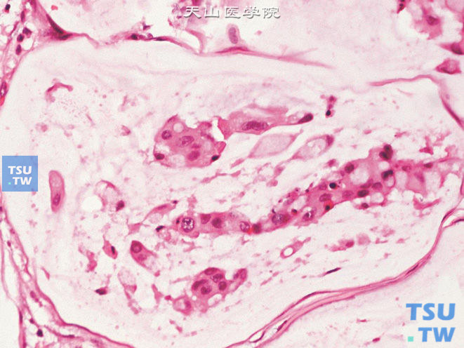 膀胱腺癌，黏液（胶样）型，上图高倍，示漂浮于黏液湖中肿瘤细胞富含黏液