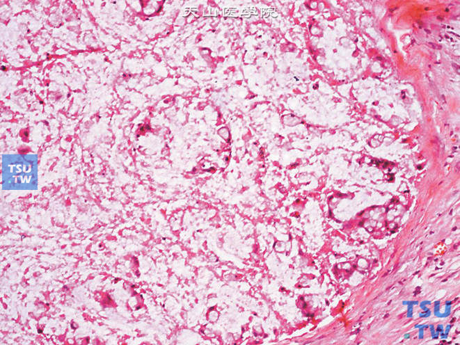 膀胱腺癌，印戒细胞型，可见印戒细胞及大片坏死