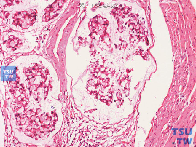 膀胱腺癌，印戒细胞型，可见印戒细胞浸润肌层