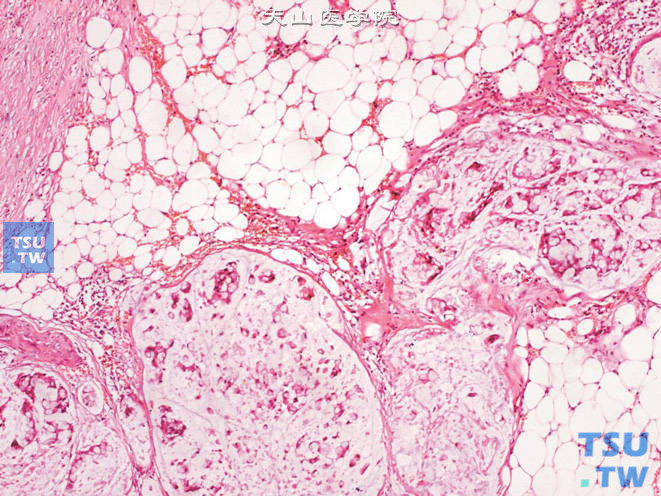 膀胱腺癌，印戒细胞型，可见印戒细胞浸润膀胱周围脂肪