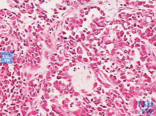 膀胱腺癌，透明细胞型，癌细胞呈平头钉状
