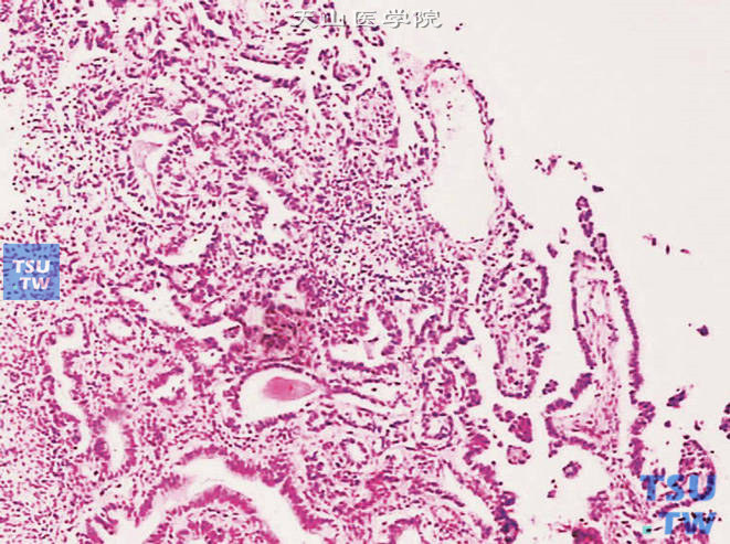 膀胱透明细胞腺癌，示瘤细胞排列成乳头状或腺管状
