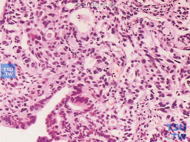 膀胱透明细胞腺癌，示瘤细胞呈腺管状排列，并可见微囊状扩张的腔隙