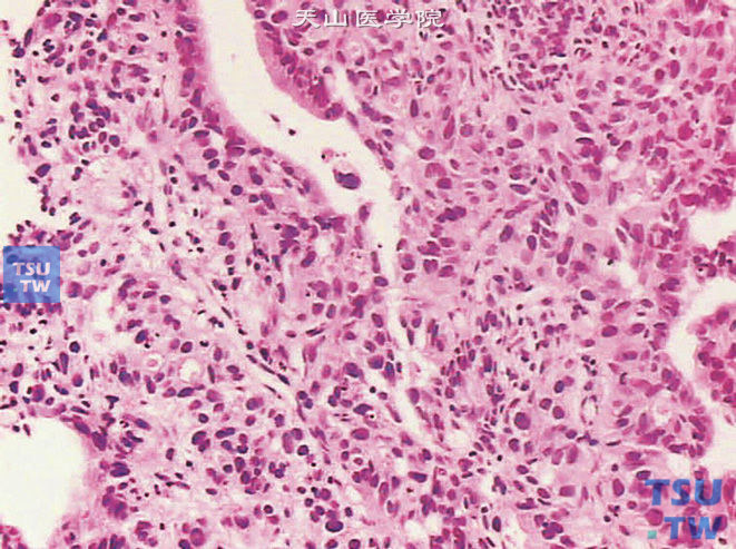膀胱透明细胞腺癌，示瘤细胞异型性明显