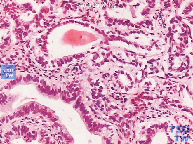 膀胱透明细胞腺癌，示瘤细胞胞质透明
