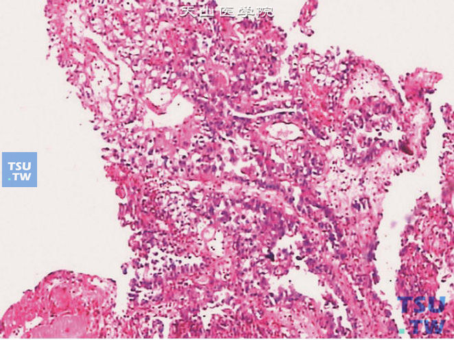 膀胱透明细胞腺癌（膀胱底），肿瘤呈乳头状或管状结构，可见微囊状扩张的腔隙