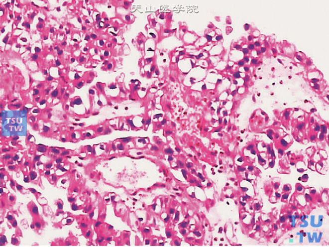 膀胱透明细胞腺癌（膀胱底），胞质丰富透明，异型性明显
