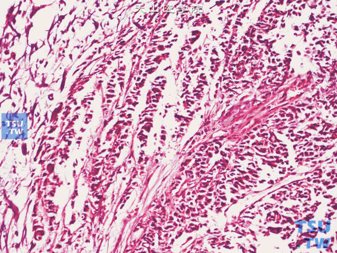 膀胱小细胞癌，由形态一致的小细胞构成，细胞质缺乏，核大小一致