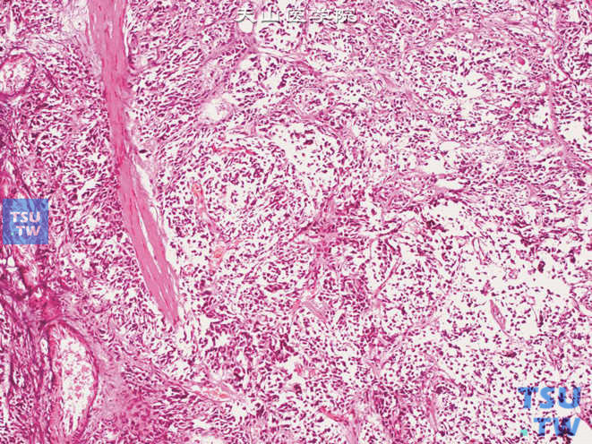 膀胱小细胞癌，示肿瘤侵犯膀胱肌层