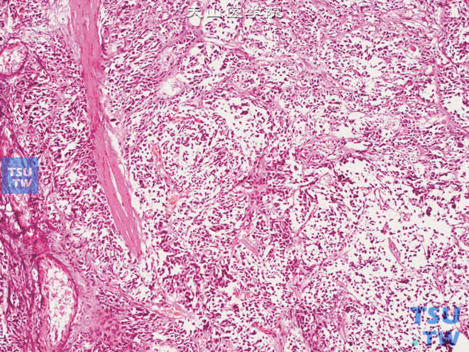 【图】膀胱小细胞癌病理图谱 - 泌尿系统 - 天山医学院